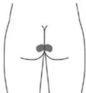 TensCare Alivia - Electrodo para la piel opcional para URGE (Esto puede no ser tan efectivo como la estimulación con la sonda vaginal) - 2
