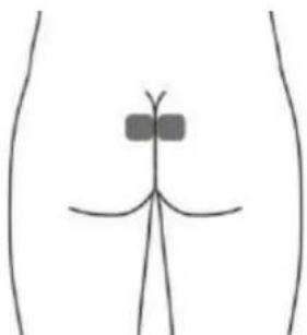 TensCare Alivia - Optional skin surface electrode placement for URGE (this may not be as effective as the stimulation with the vaginal probe). - 1