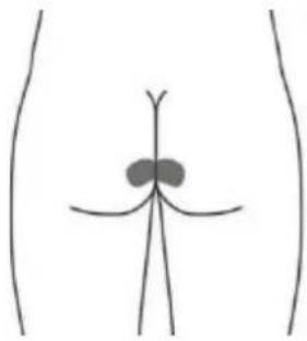 TensCare Alivia - Optional skin surface electrode placement for URGE (this may not be as effective as the stimulation with the vaginal probe). - 2