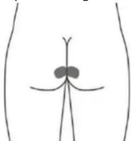 TensCare Alivia - Optionale Elektroden für DRANG (URGE) (dies ist möglicherweise nicht so effektiv wie die Stimulation mit der Vaginalsonde). - 1