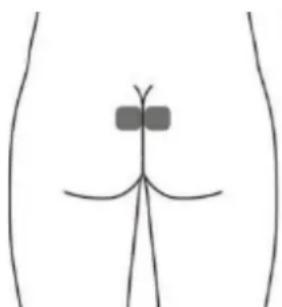 TensCare Alivia - Electrodo para la piel opcional para URGE (Esto puede no ser tan efectivo como la estimulación con la sonda vaginal) - 1