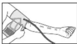 Medel Elite - Applicazione del bracciale - 2