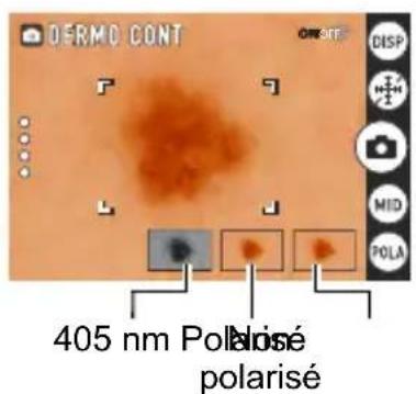 DERMO CONT 405 nm Polisé polarisé