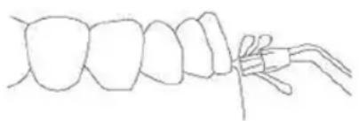 Sogo SS-12360 - Dental plaque tip - 1