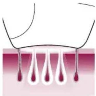 PHILIPS Lumea Advanced BRI920/00 light depilation - Principe de fonctionnement de la lumière pulsée intense - 1