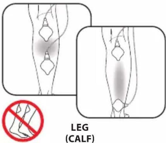 LEG (CALF)
