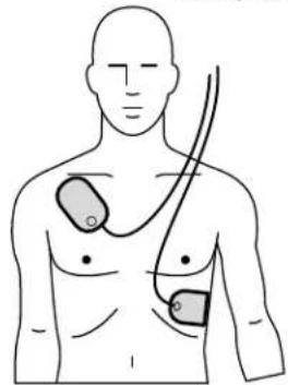 PHILIPS HeartStart FR2+ M3861A - Step I: Preparation - 2