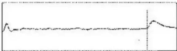 Aortic X-ray's AC mass for pulmonary embolism is measured, but a 3D scan is performed at the end of the 2000-2010 period. The 2000-2010 period was measured by the end of the 2000-2010 period.