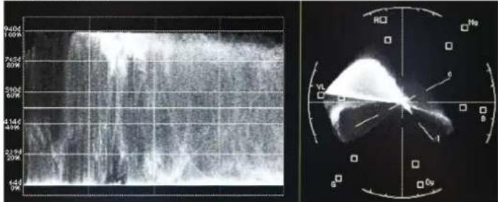 Medical ultrasound image with Doppler flow graph and corresponding radiographic scan of heart chambers