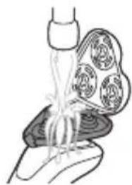 Illustration of a medical procedure showing tissue manipulation with a bulb (no text or symbols)