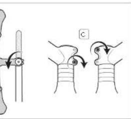 Medical diagram illustrating surgical technique steps with labeled arrows and a square marker indicating point C.