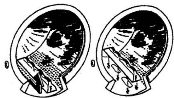 Two cross-sectional medical illustrations showing internal anatomical structures (no text or labels)