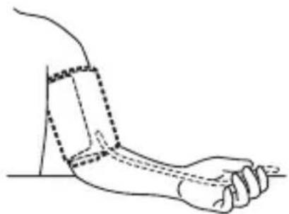 OMRON Comfort Cuff - Huomaa: Liitä letkuun laitettasi vastaava ilmaletkun liitin. Mansetin asetus - 1