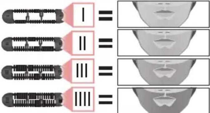 Diagram illustrating four stages of a medical procedure involving a device, with visual examples showing progressive alignment and deformation.