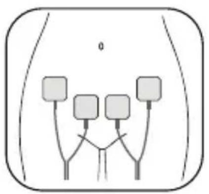 Luvion Pelvic Floor Trainer - Electrode Pads Placement - 1