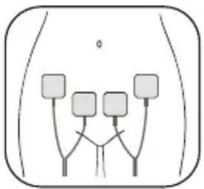 Luvion Pelvic Floor Trainer - Plaatsing van de Elektrodepads - 1