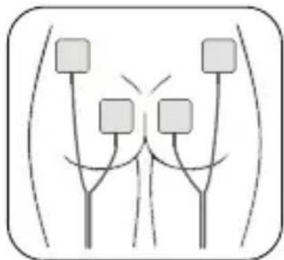 Luvion Pelvic Floor Trainer - Platzierung der Elektropads - 3