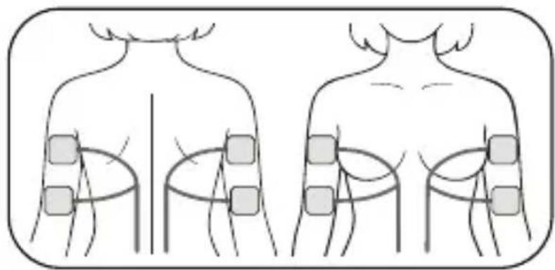 Luvion Pelvic Floor Trainer - Positionnement des électrodes adhésives - 2