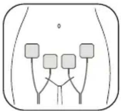Luvion Pelvic Floor Trainer - Positionnement des électrodes adhésives - 1