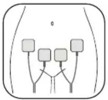 Luvion Pelvic Floor Trainer - Platzierung der Elektropads - 1
