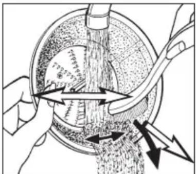 Medical illustration showing surgical procedure with labeled anatomical structures and force arrows