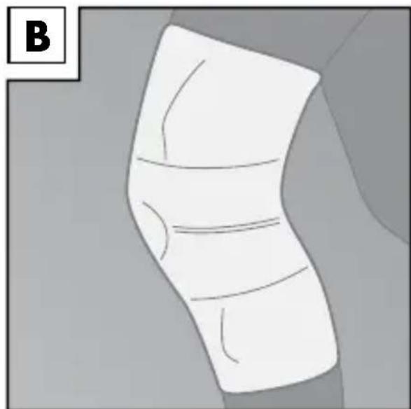 Sensiplast IAN 90365 - Applying the brace - 2