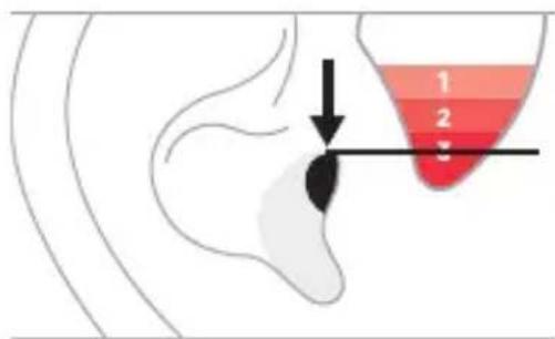 Anatomical diagram showing a human ear with a color gradient scale from 1 to 3, highlighting a specific area.