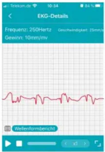EKG-Details Frequenz: 250Hertz Geschwindigkeit: 25mm/s Gewinn: 10mm/mv Wellenformbericht