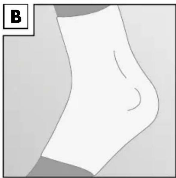 Sensiplast IAN 113152 - Applying the brace - 2