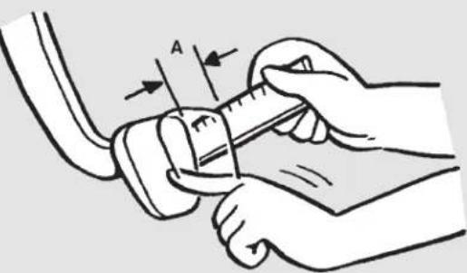 Diagram illustrating a medical procedure with labeled arrow 'A' indicating direction or point of motion