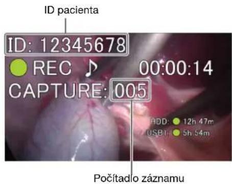 ID pacienta ID: 12345678 REC 00:00:14 CAPTURE: 005 HDD: 12h 47m USB1: 5h 54m Počítadlo záznamu