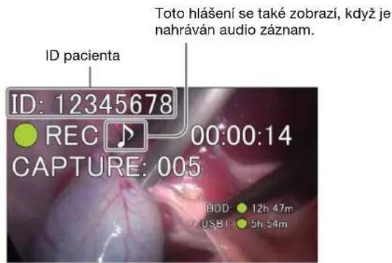 ID pacienta Toto hlášení se také zobrazí, když je nahráván audio záznam. ID: 12345678 REC 00:00:14 CAPTURE: 005 ADD: 12h 47m USB 5h 54m