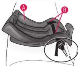 Medical diagram showing anatomical structures labeled A and B with a magnified inset of a device or instrument.