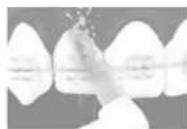 PANASONIC EW1513 - Orthodontisch spuitstuk - 1