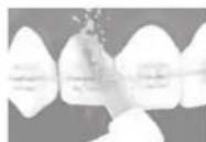 PANASONIC EW1513 - Orthodontische Düse - 1