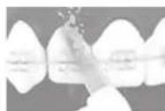 PANASONIC EW1513 - Canule orthodontique - 1