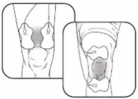 OMRON Max Power Relief PM500 - STEP 1 – PAD PLACEMENT (continued) - 1