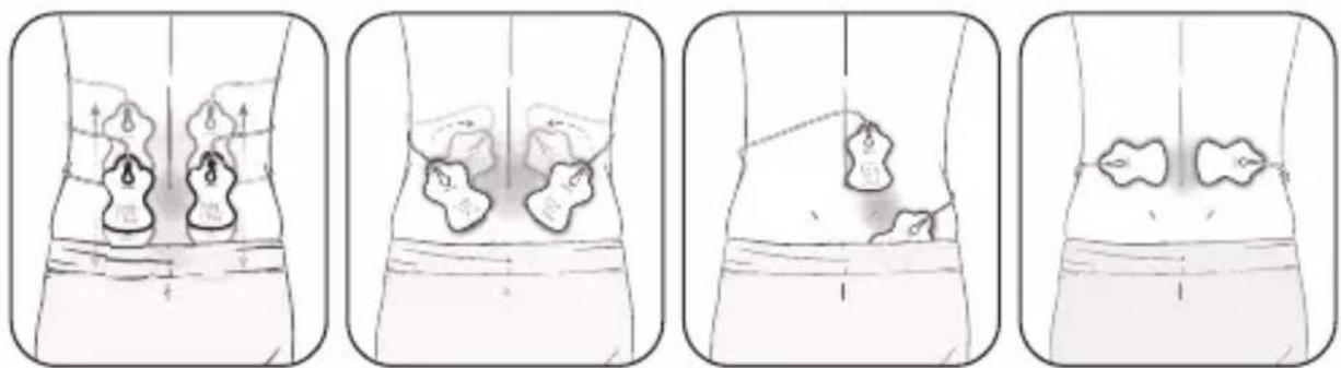 Medical illustration showing four stages of abdominal pain with labeled anatomical regions and directional arrows indicating movement or pressure points.