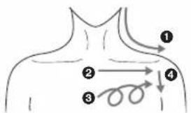 Diagram of human shoulder anatomy with numbered labels indicating anatomical or pathological features