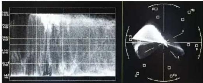 Medical imaging scan with annotated radiographic parameters and a corresponding CT scan of the heart chamber.