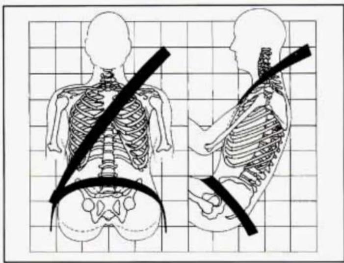 Medical diagram showing human skeletal anatomy with a diagonal band and corresponding view of the human torso, likely illustrating spinal cord placement or measurement.