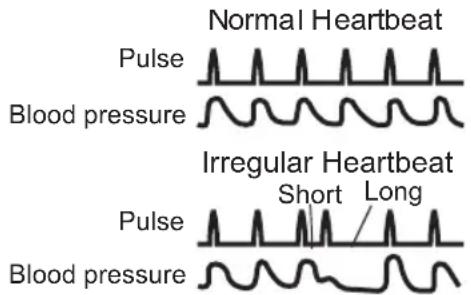 Normal Heartbeat Pulse Blood pressure Irregular Heartbeat Pulse Short Long Blood pressure