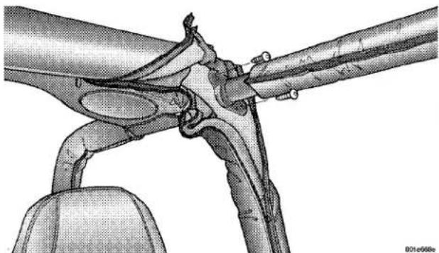 Medical illustration of a surgical procedure involving a tool and tubing (no text or labels)