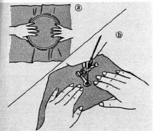 Medical illustration showing two steps of a surgical procedure on a patient's abdomen, labeled (a) and (b), with hand placement and tool insertion.