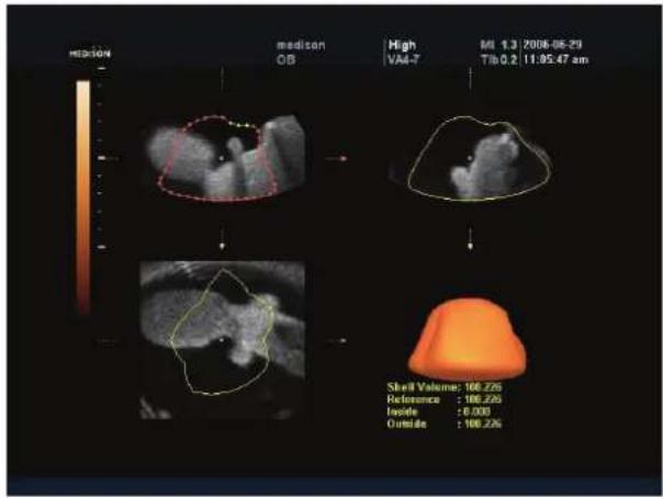 medison OB High VAS-7 MI 1.3 2006-06-29 Tib 0.2 11:05:47 am Shell Volume: 100.226 Reference: 100.226 Inside: 0.000 Outside: 100.226