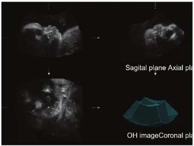 Sagital plane Axial pla OH imageCoronal pla