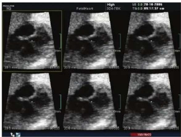 PROLOT 50d FetalHeart High 3D4-7EK MI 0.0:28-16-2005 Tib 0.0:09:17:37 am 20.1 mm 20.2 mm 20.3 mm 20.4 mm 20.5 mm 20.6 mm 20.7 mm 20.8 mm 20.9 mm 130/6/23