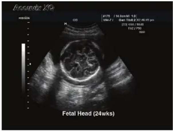 Accumix XO MISIGN OB #175 / 14.0cm MI 1.0 VA4-7 / Gen Tlb0.2 02:46:45 pm [20] GSb / 90/81 FA2 / P90 IMR Fetal Head (24wks)