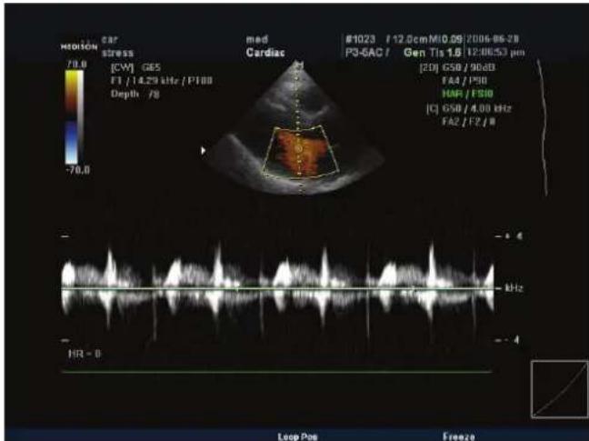 MEDITION CAR stress 70.0 [CW] GE5 F1 / 14.29 kHz / P188 Depth /8 med Cardiac #1023 / 12.0cm M10.09/ 2006-06-28 P3-GAC / Gen Tis 1.8 U20653 µm [20] GS0 / 90dB FA4 / PS0 IHP / FSB [C] GS0 / 4.00 kHz FA2 / F2 / 8 HR = 0 Loop Pos Freeze