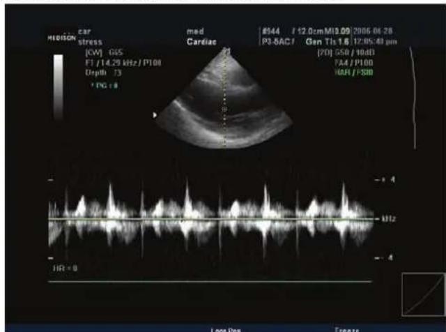 MEDISON CAR stress [CW] GGS F1 / 14.29 kHz / P100 Depth 73 *PG:8 med Cardiac P1 8944 / 12.0cmM19.09 2006-06-28 P3-SAC1 Gen Tis 16 12:05:40 µm [70] 550 / 10dB FA4 / P100 100A / PS10 -4 H12 -4 JIR = 0 Loop Pos Freeze